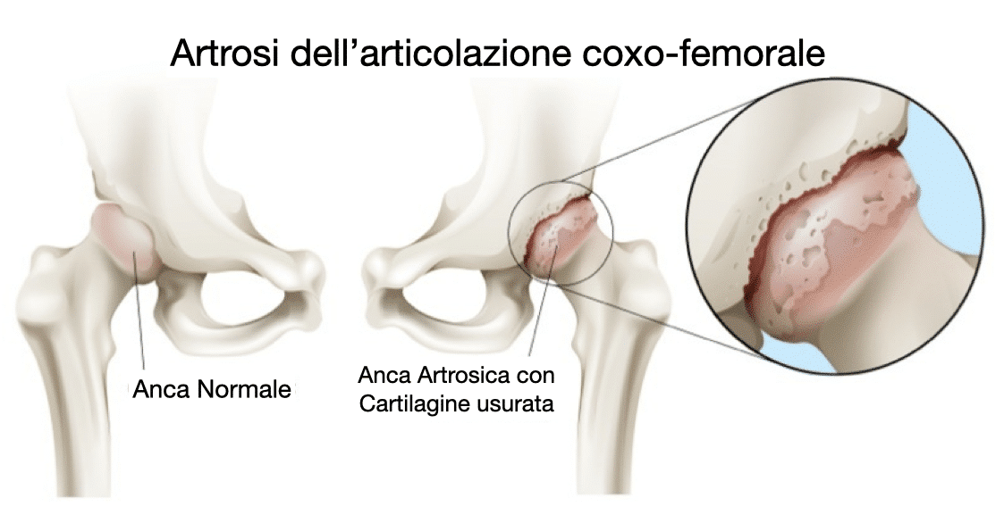 Artrosi dell'articolazione coxo-femorale