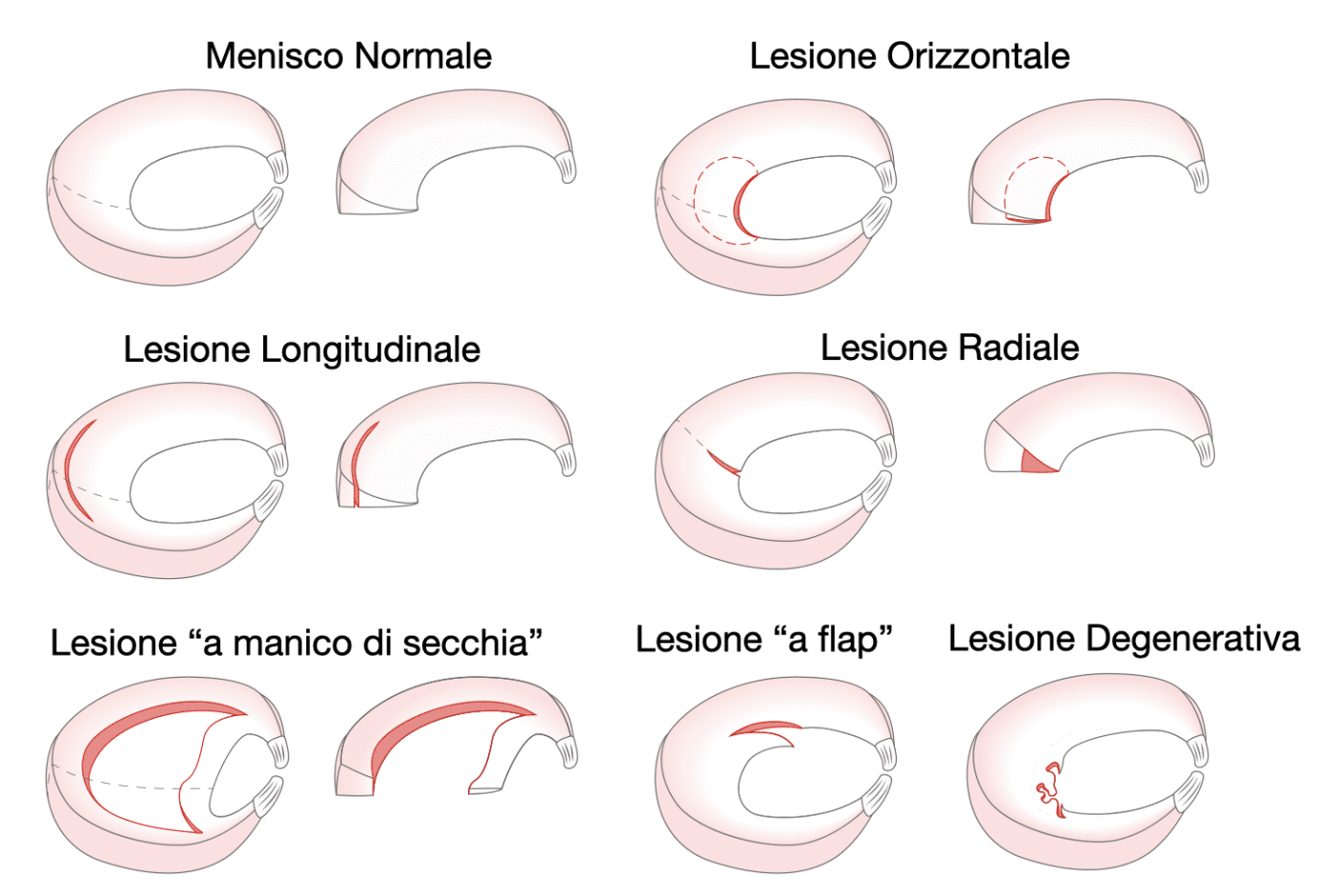 Tipologie di lesione meniscale