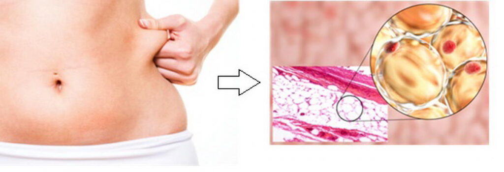 Lipogems