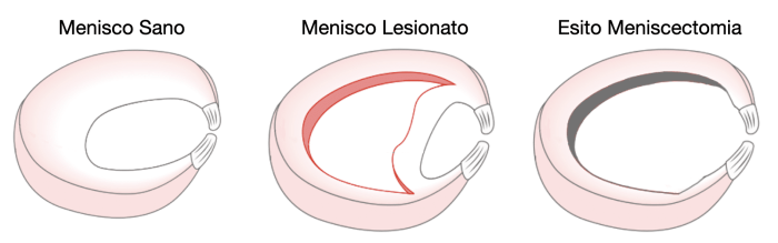 Meniscectomia selettiva