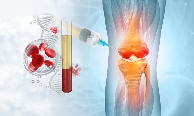 PRP – Plasma Ricco di Piastrine