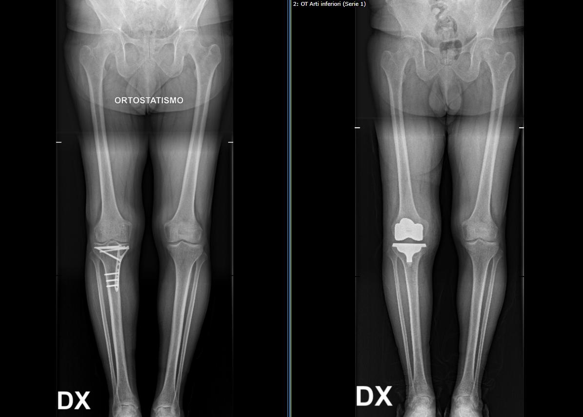 Esempio di radiografia post-operatoria di paziente con artrosi post traumatica in esito di frattura del piatto tibiale