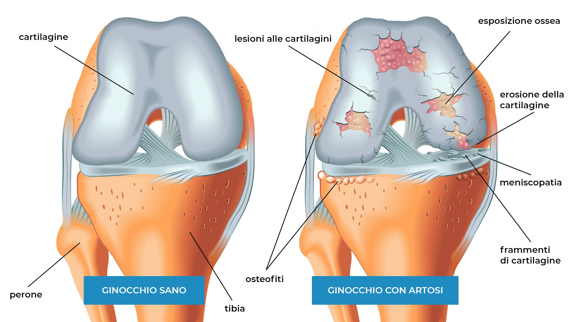 Illustrazione artrosi del ginocchio