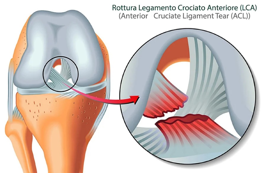 Rottura legamento crociato