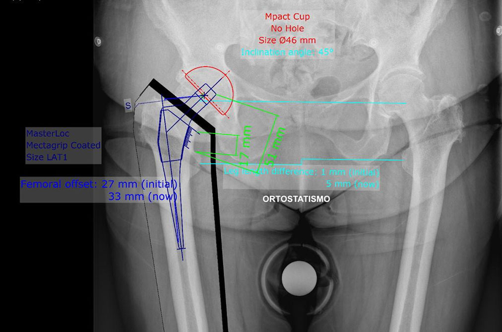 RX Pianificazione pre operatoria protesi anca