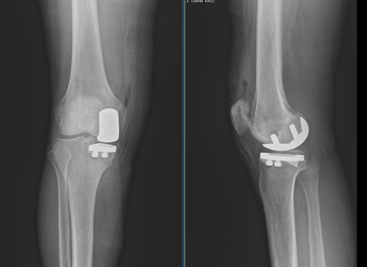 Esempio di radiografia post-operatoria di protesi monocompartimentale del ginocchio