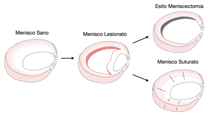 Sutura meniscale